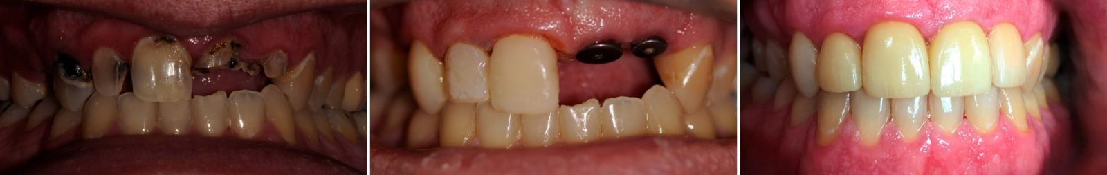 Before and after: a rebuilt smile after severe decay