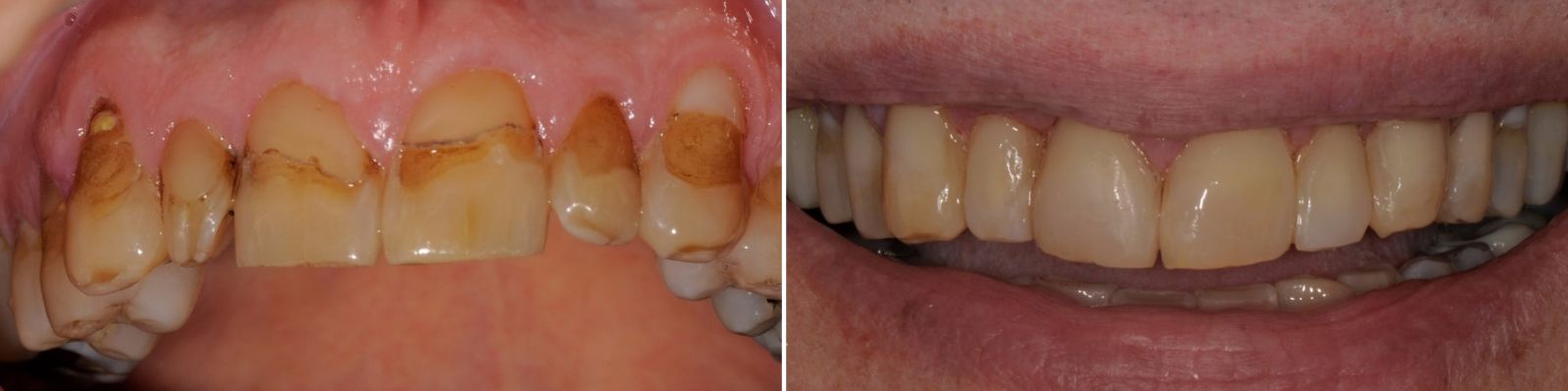 Before and after: a more balanced smile without crowns or braces