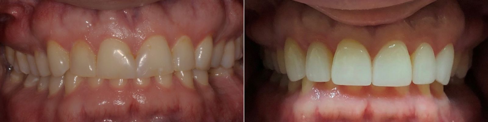 Before and after: a more balanced, natural-looking smile with veneers