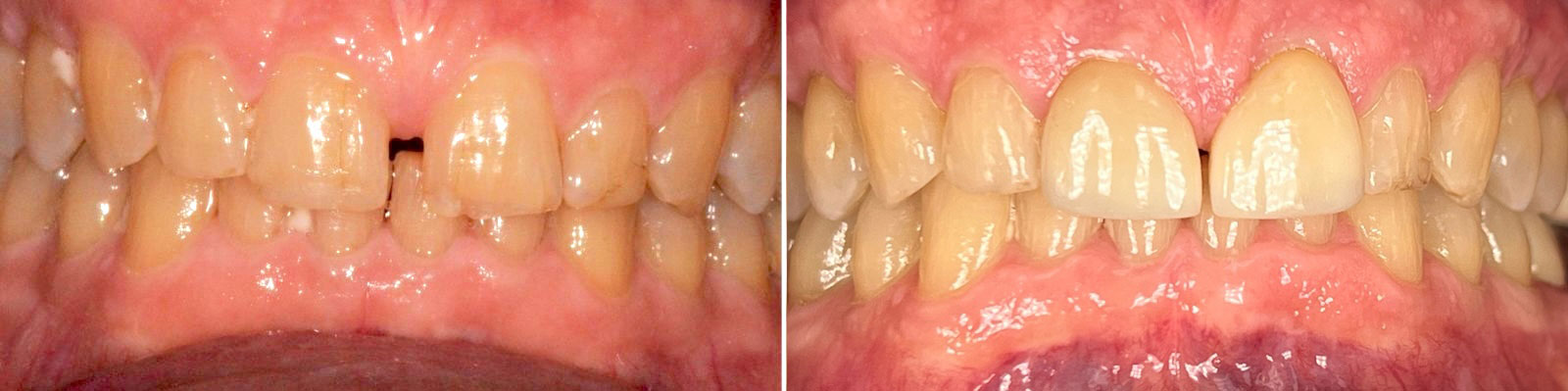 Before and after: a subtle veneer enhancement that preserved his smile